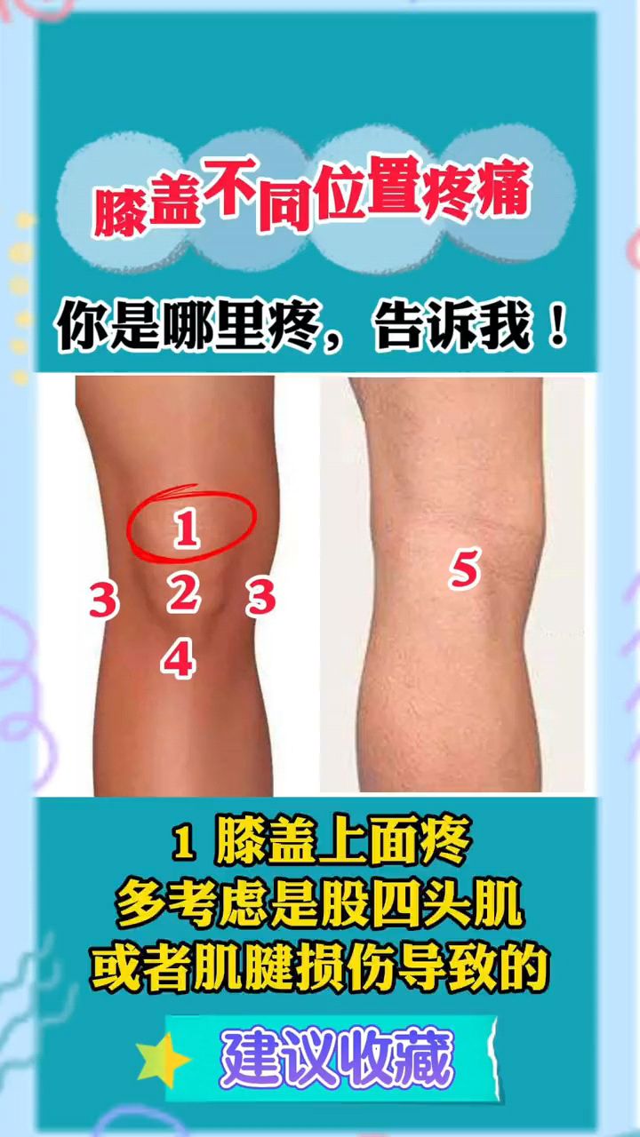 膝盖不同位置疼痛,你是哪里疼,告诉我!