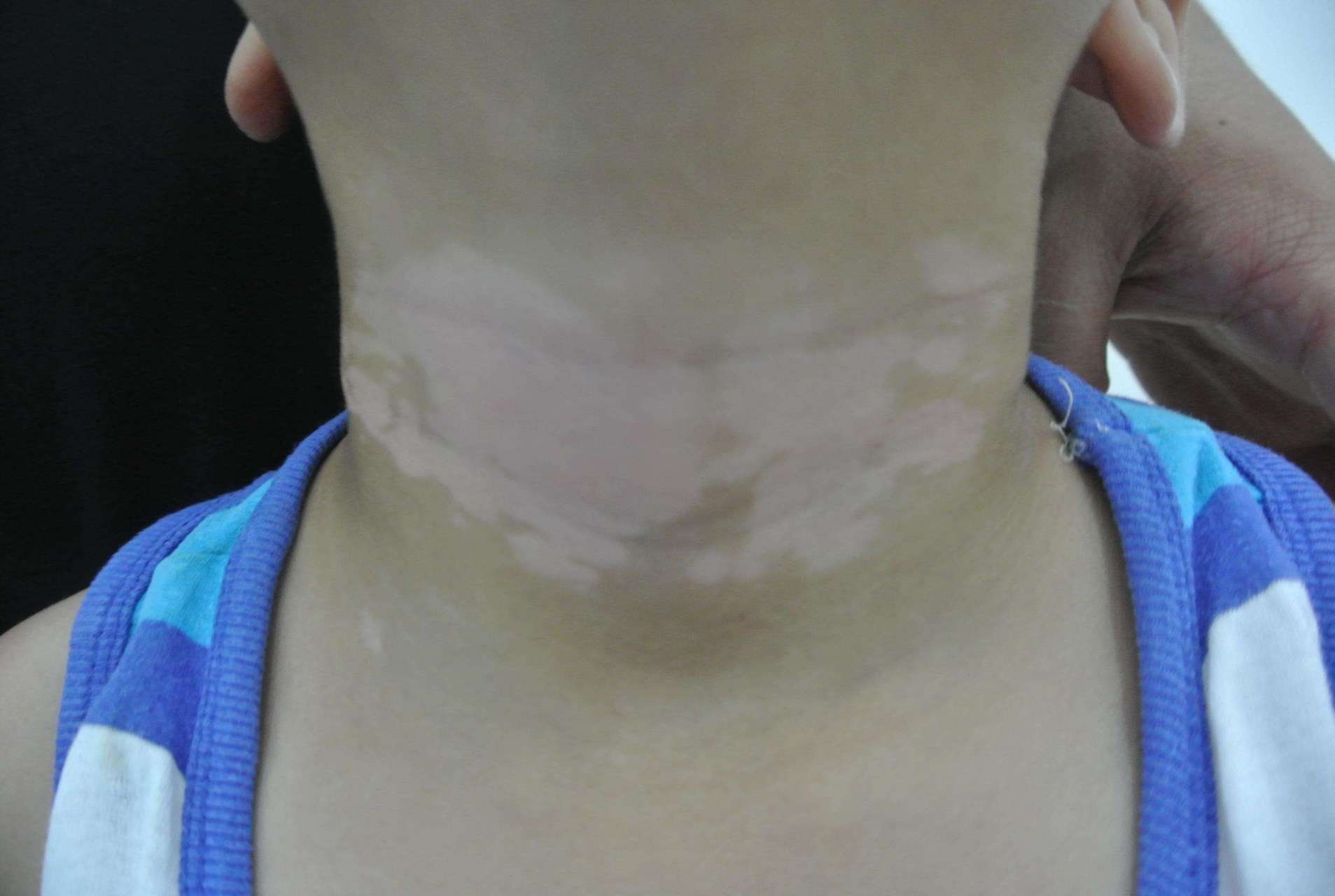 可以到皮肤科,白癜风是一种后天性的局限性或泛发性皮肤色素脱失病,由