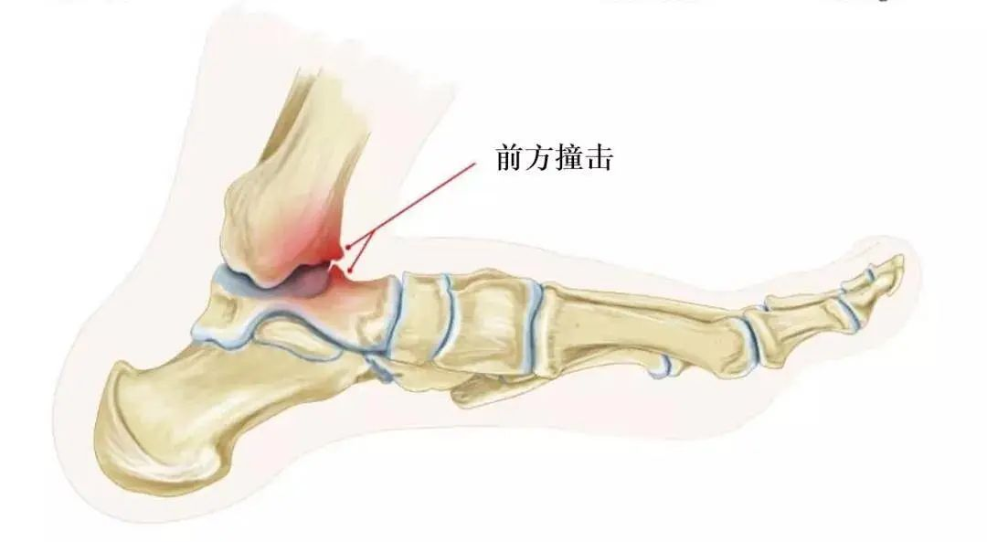 踝关节扭伤后反复疼痛,需警惕"踝关节撞击综合征"!