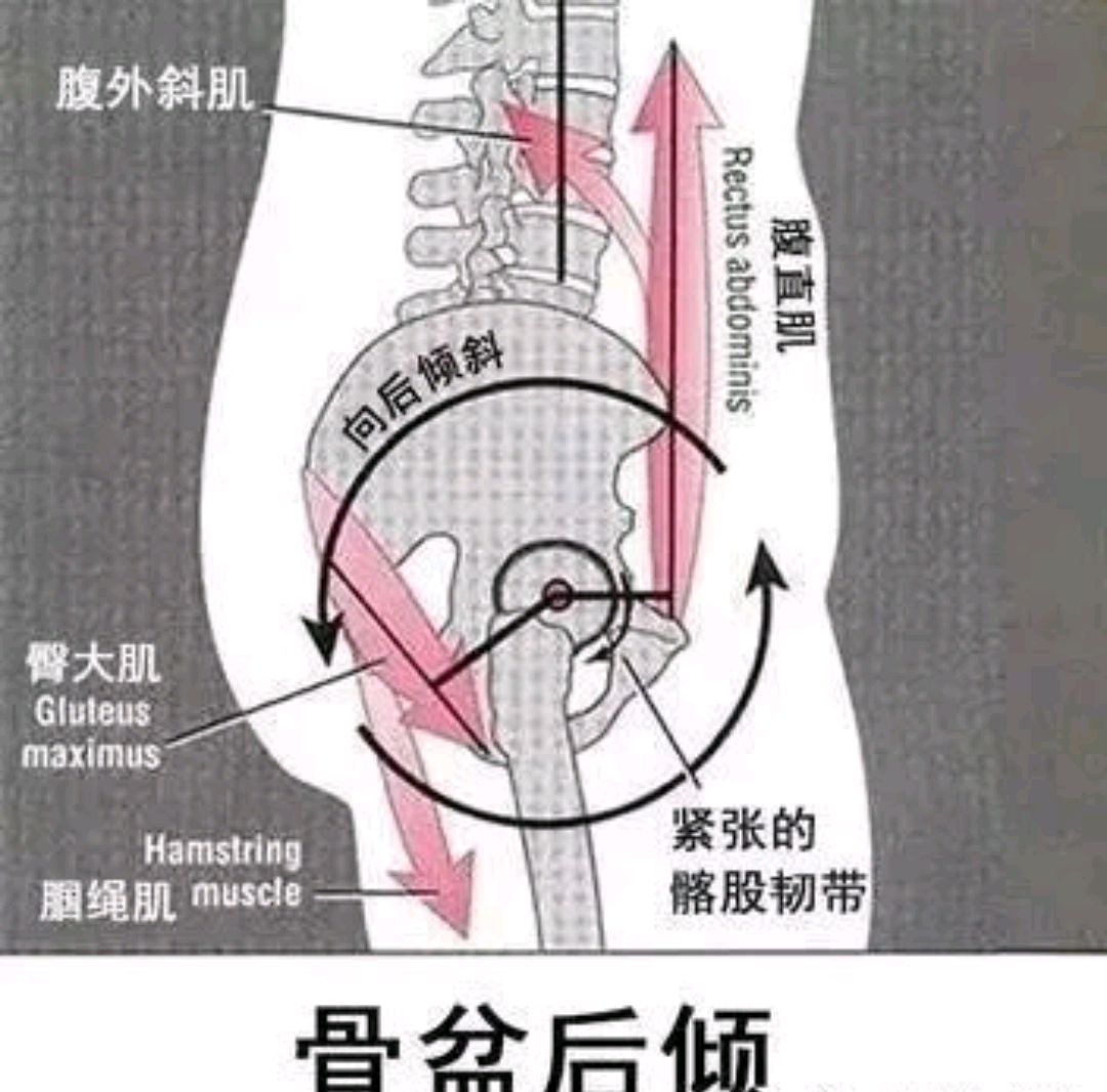 骨盆后倾的判断图图片