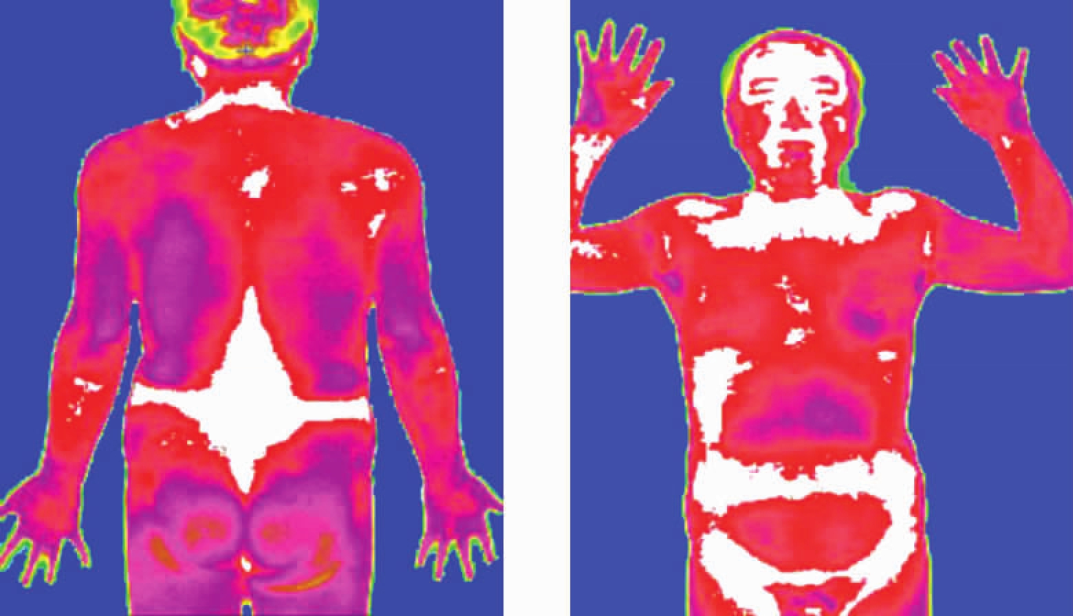 医用热成像技术用于血管疾病的诊断