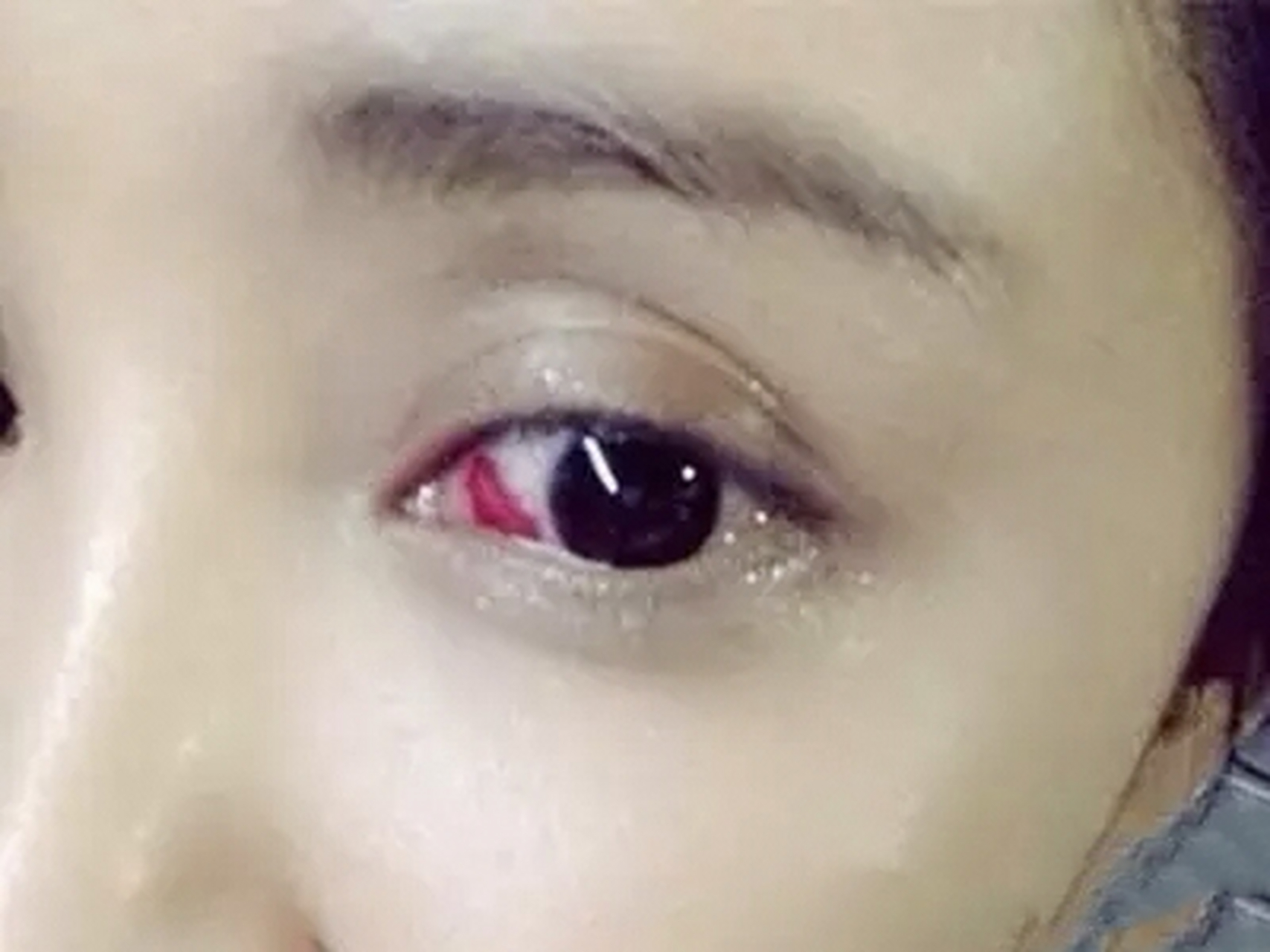 白眼球出血怎么办 在我们超视立唐山店经常会碰到有顾客来的时候