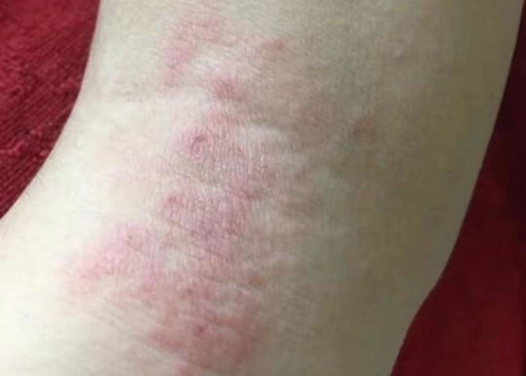 皮疹越抓越厚 这可不是湿疹!