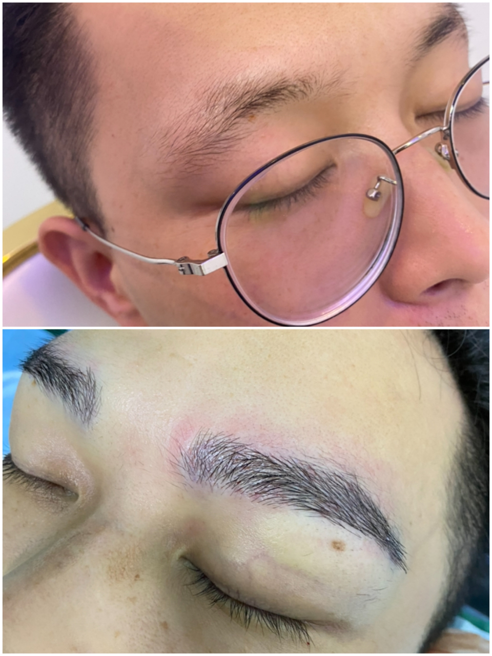男士种植眉即刻对比 跟随终身的活眉毛