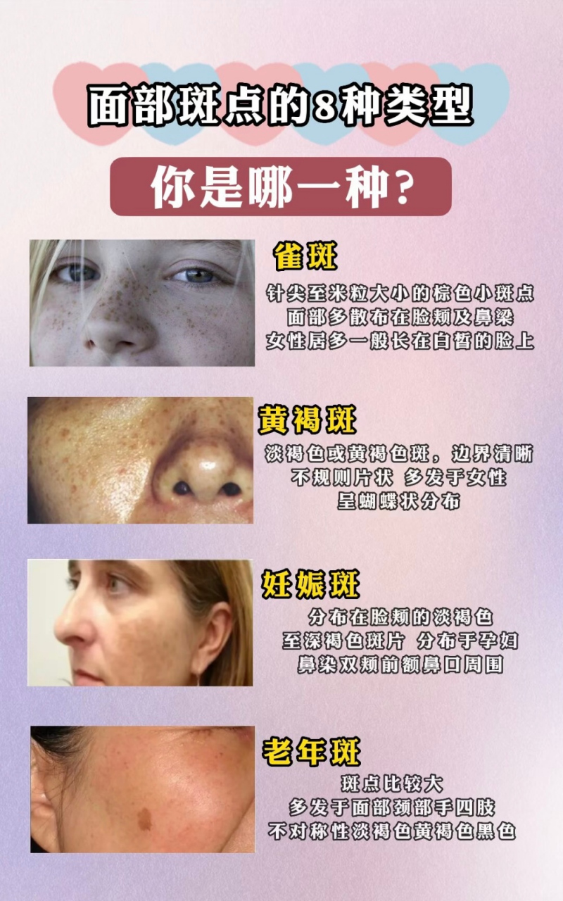 面部斑点的8种类型,你是哪一种?