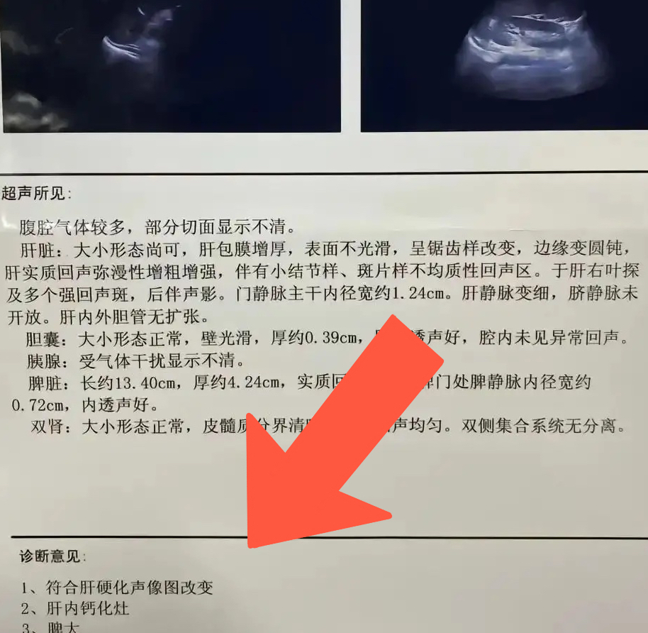 肝硬化为何脾大?要不要切脾?