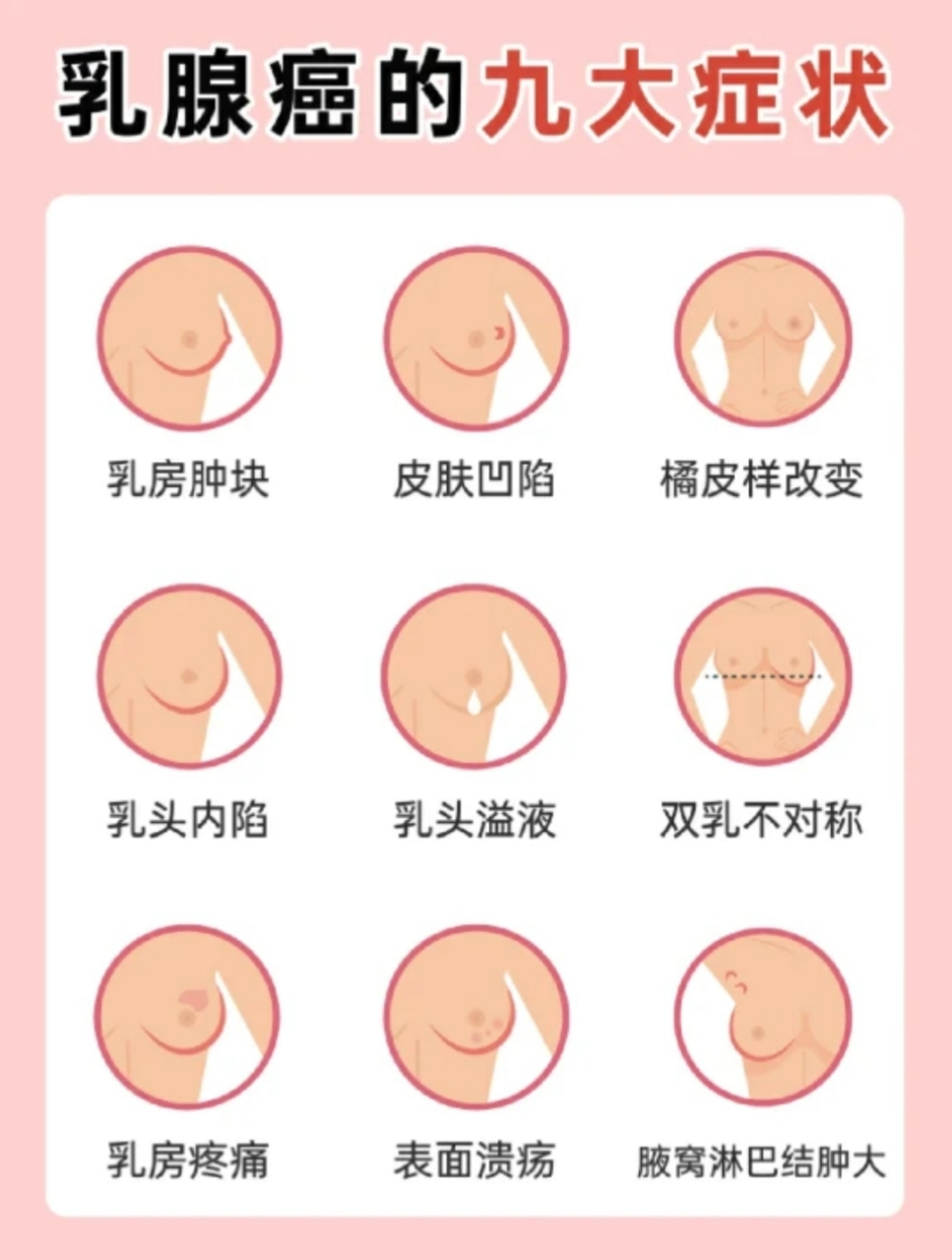 乳腺癌的九大症状  早期出现乳腺结节,乳腺增生,乳腺囊肿,一定引起