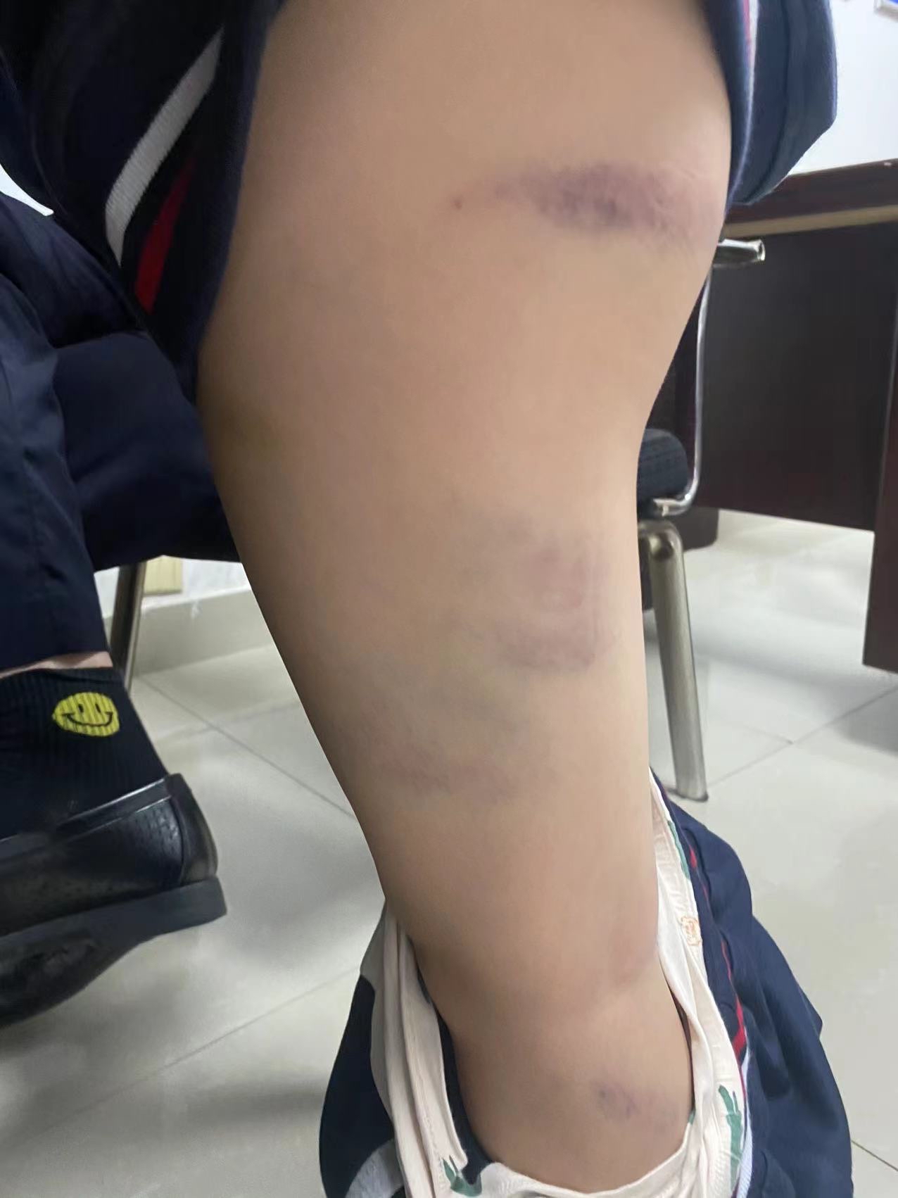 用竹尺子殴打孩子导致孩子在地上打滚,全身多 打架受伤照片被打的淤青