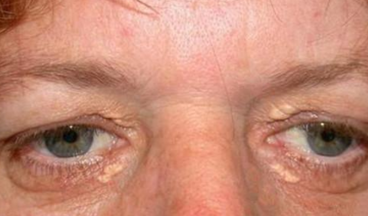 胆固醇高不高,眼睛先知道?胆固醇偏高的人,多半有这4个表现