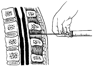 鞘内注射部位图片