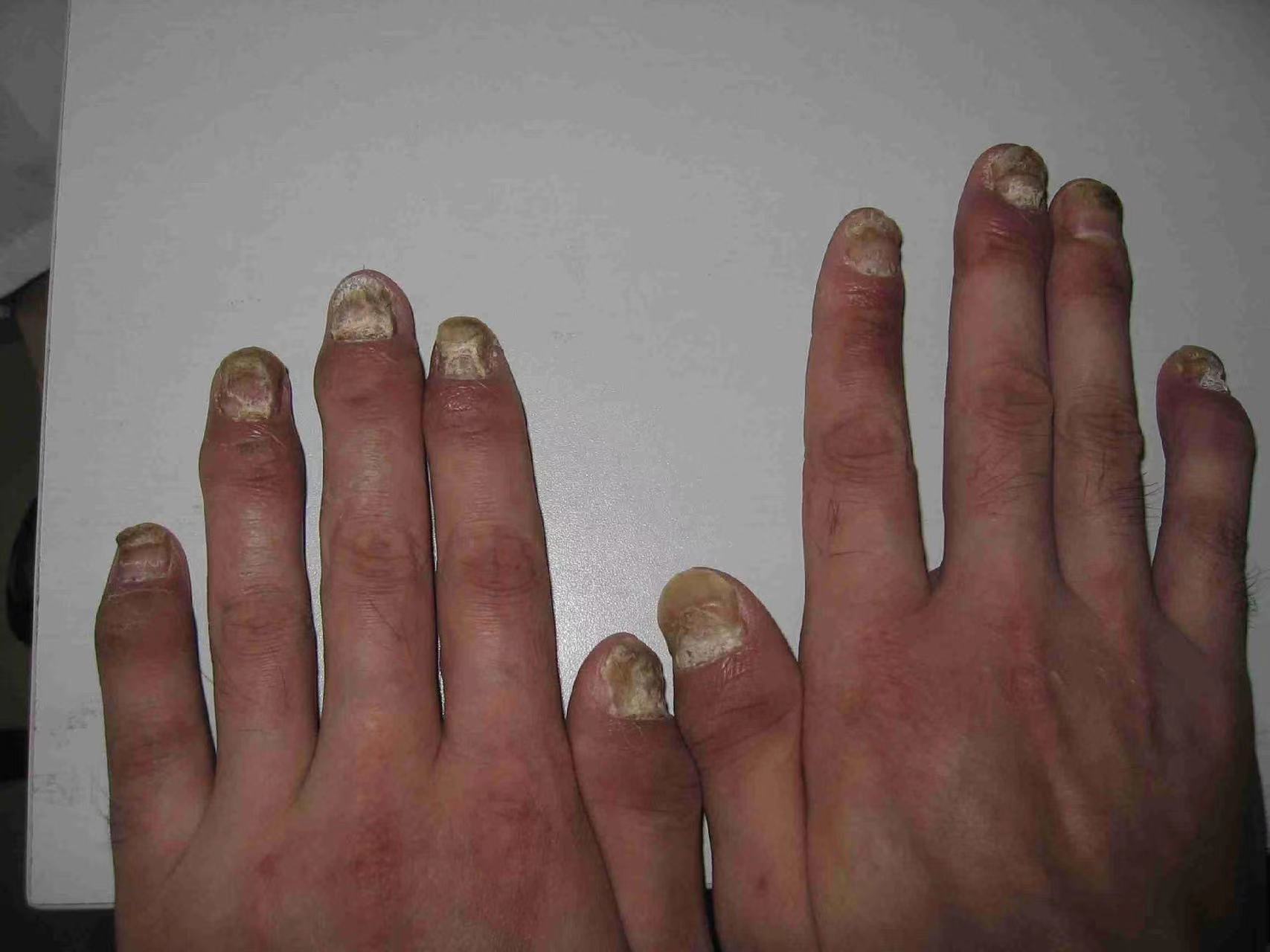 千万不能忽视这类银屑病………… 不能忽视的银屑病关节炎合并症.