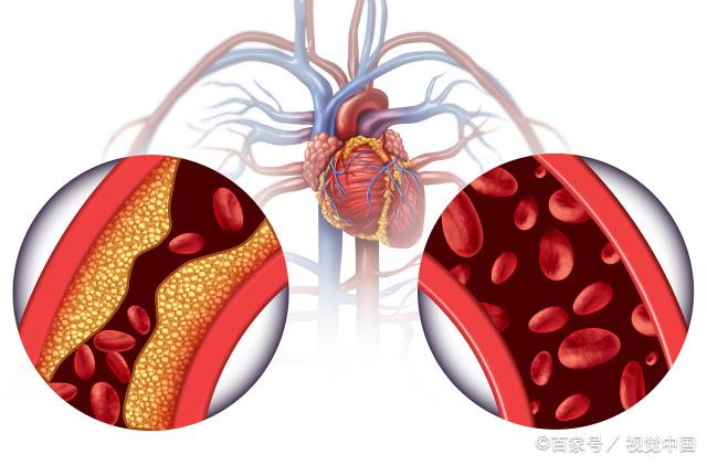 动脉粥样硬化不是"粥",轻度狭窄的血管,吃药了还能恢复原状么