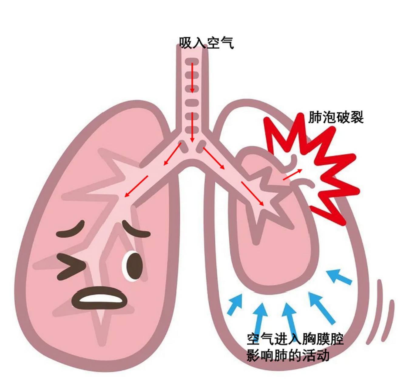 瘦高體型的男性比女性更容易發生原發性自發性氣胸?