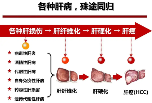 肝炎到肝硬化到肝癌,中西医结合治疗阻止疾病进展!