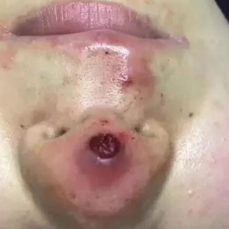 线雕隆鼻的3大危害!