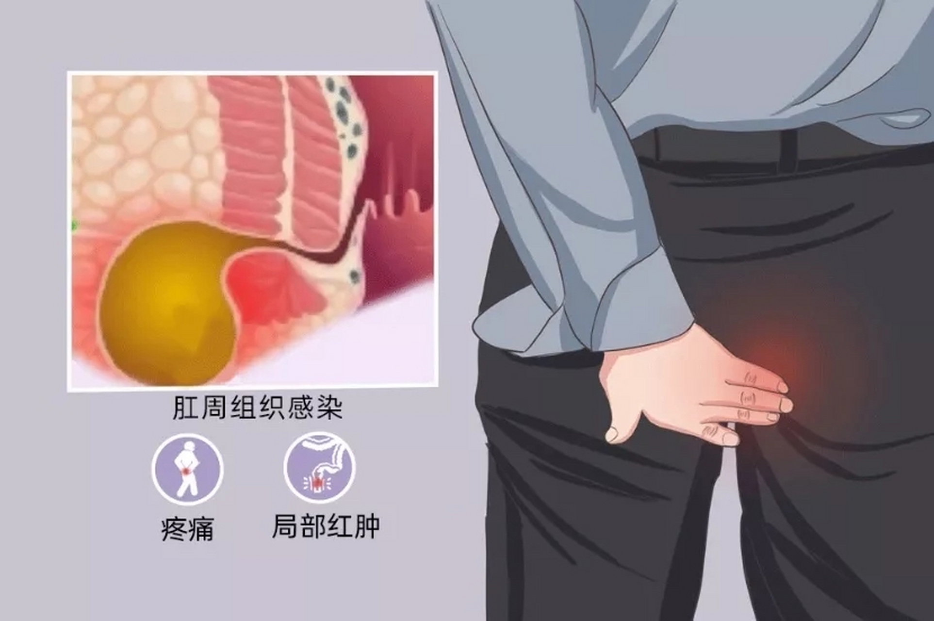 肛周脓肿本身是一种感染性疾病,导致感染的原因也非常多,那么最新的一