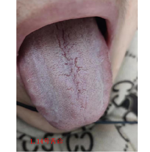 血管堵不堵,"舌"先知!1个中成药,清瘀血,化瘀堵!