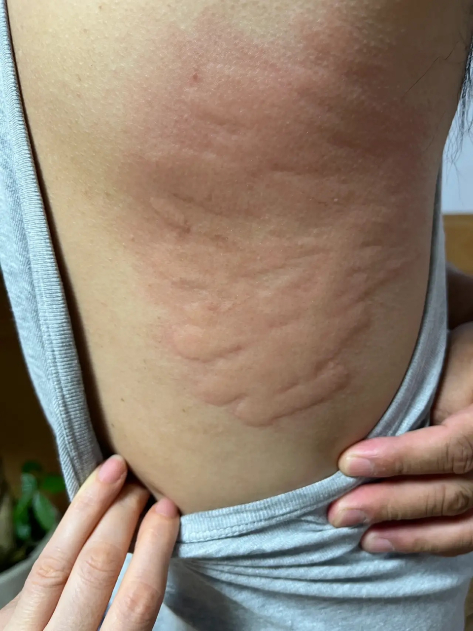 最近不知道怎么了,每天晚上浑身奇痒无比,手一抓皮肤就暴起一大块,看