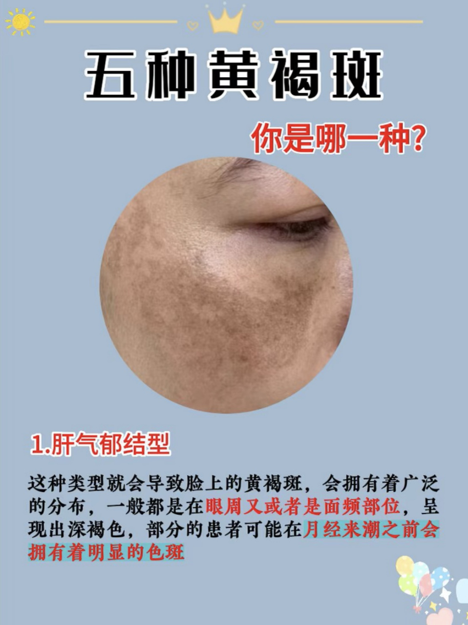 五种黄褐斑类型,看你是哪一种