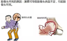 股骨头坏死的原因是什么?应该注意什么?