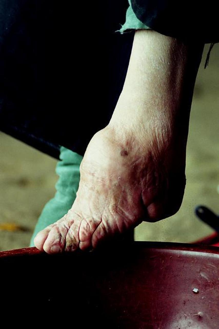 女子从四五岁便开始缠足,在这个期间要忍受剧烈的疼痛,直到骨骼定型