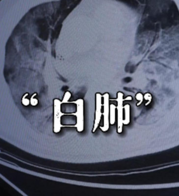 医生:不断咳嗽,先别乱吃药!结合这些症状,可能是"白肺"!
