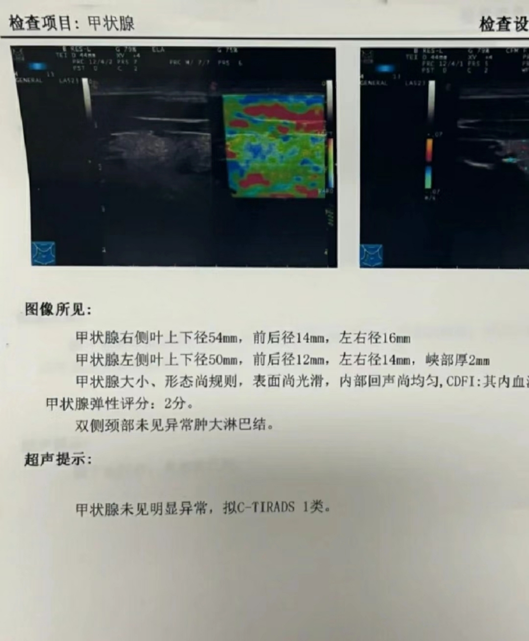 甲状腺4a结节成功逆转1类!希望结节朋友都有这一天!