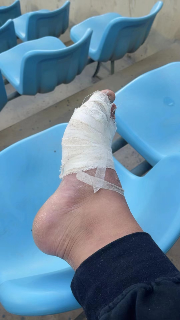 咱就是说什么是铁杆球迷,即使脚受伤了也要到球场支持自己的主队,球迷