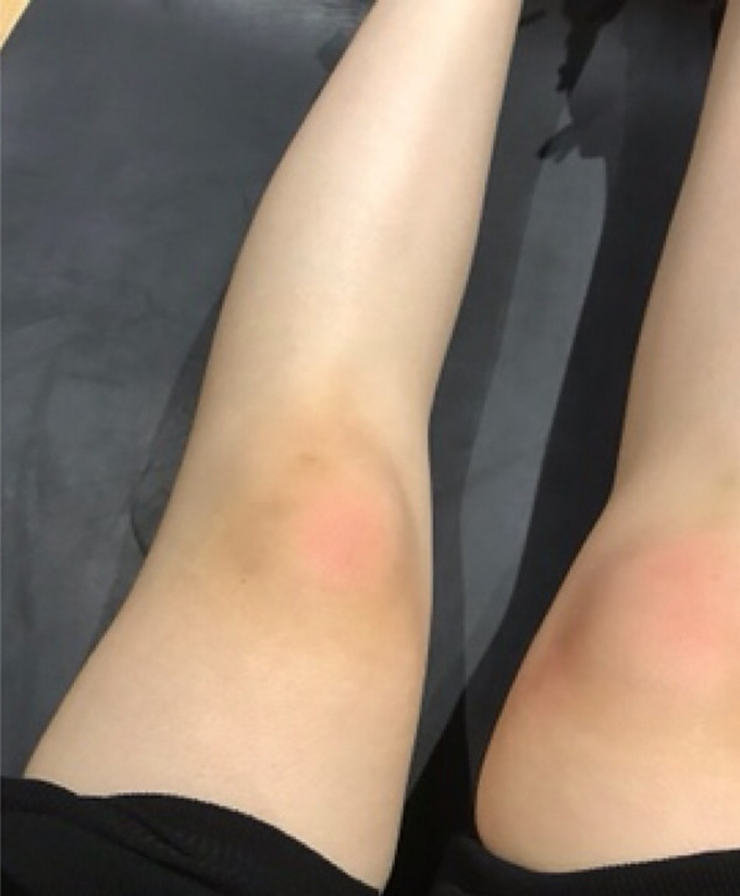 老婆每次出差回来膝盖经常有淤青,红肿.