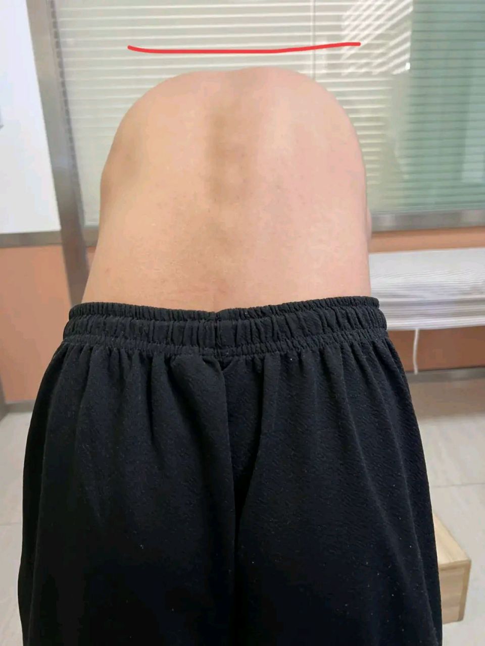 发现小孩的脊柱侧弯,如果掌握以下几点,对于比较明显的脊柱侧弯,是