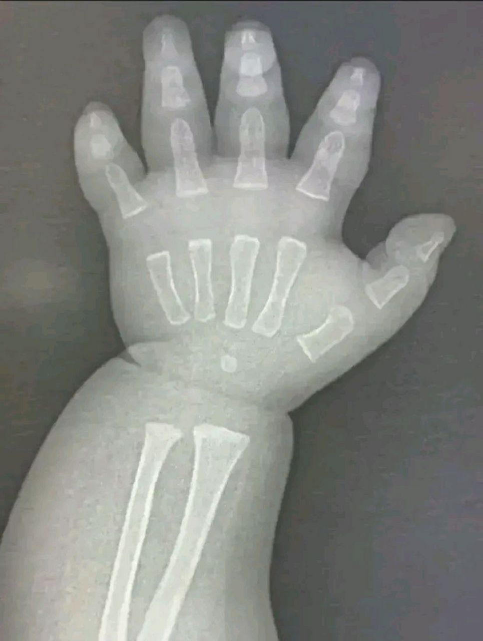 这是医院拍的x光片子.仔细一看,是一只小孩子的手.