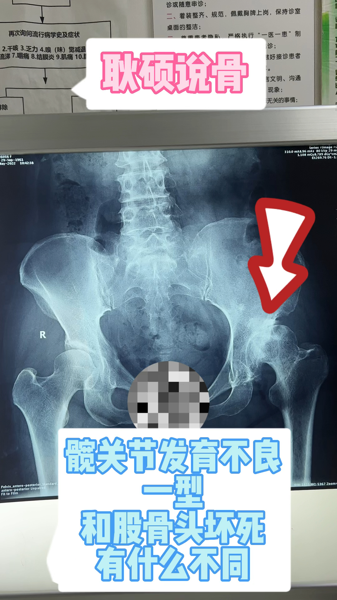 髋关节发育不良一型什么样和股骨头坏死有什么不同置换时可能需要调节