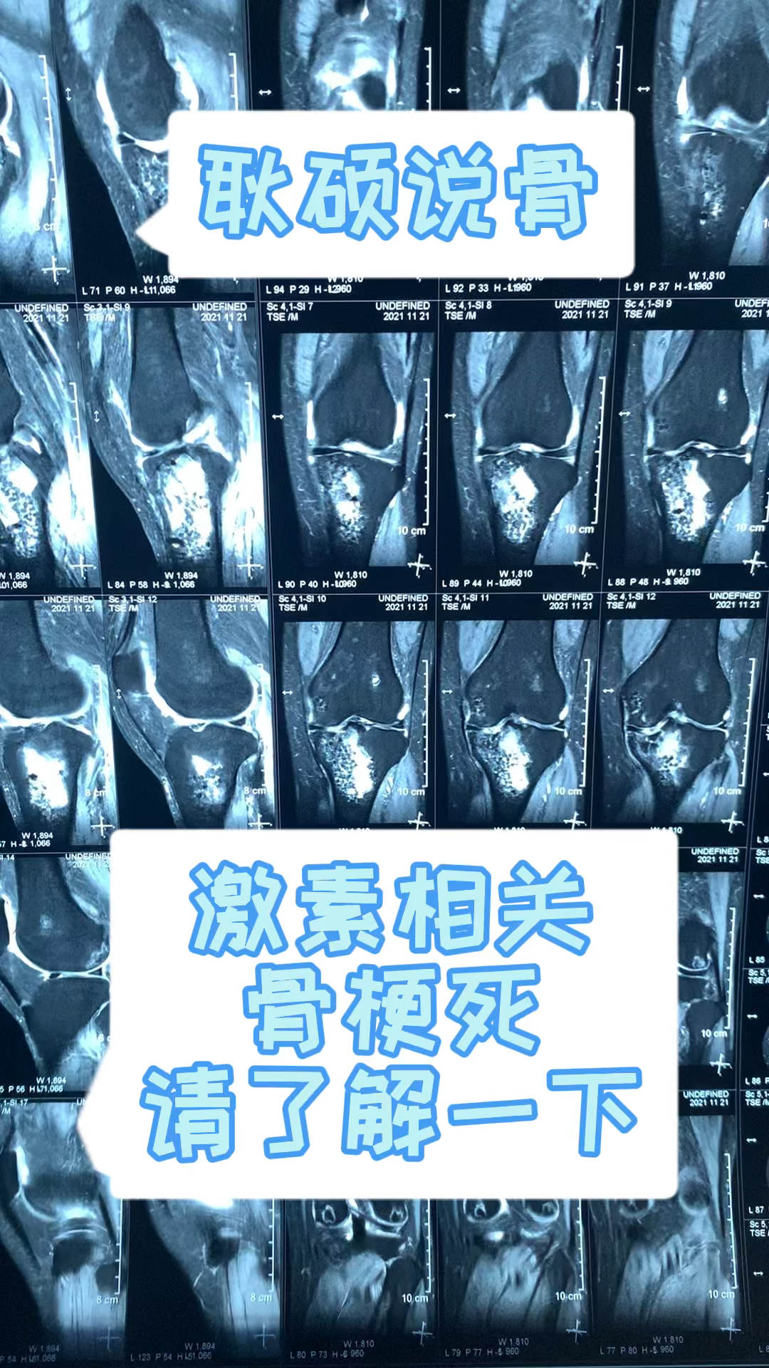 激素相关的骨梗死请大量应用激素的朋友了解下磁共振能发现