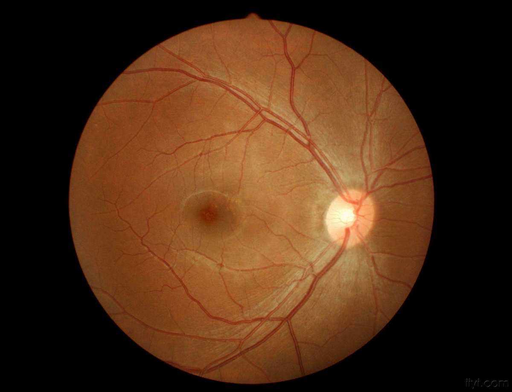 高度近视不仅影响眼睛外观,因眼轴延长,造成眼球凸出,还会发生眼球壁