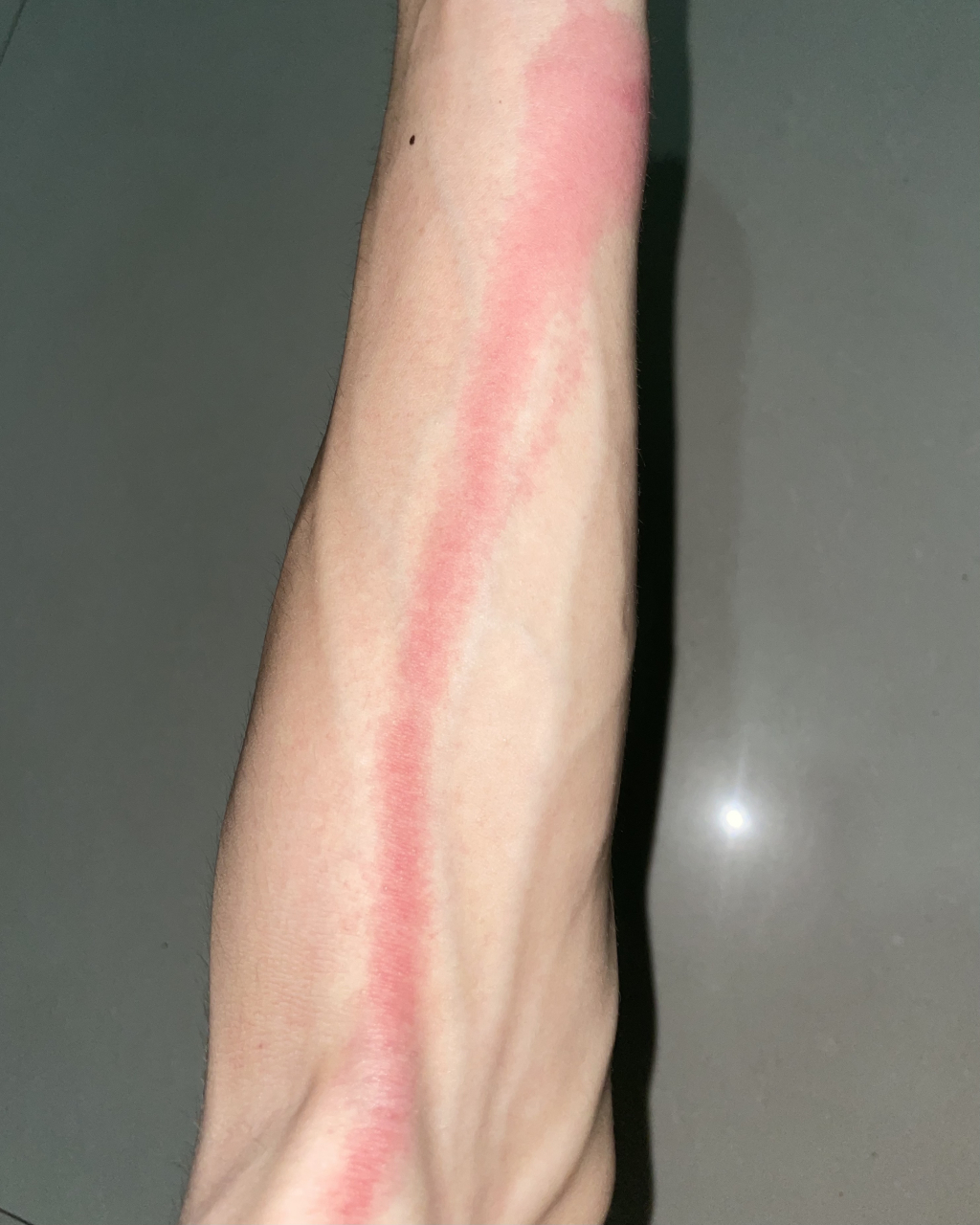 被蚊子咬到静脉炎