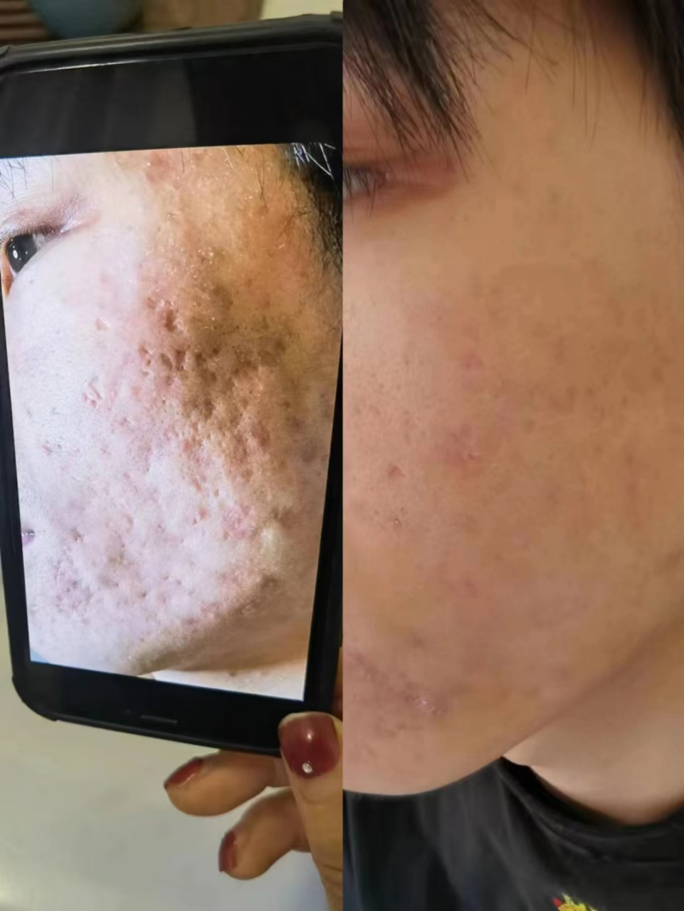 你还在为脸上的坑坑洼洼而烦恼吗?#痘坑