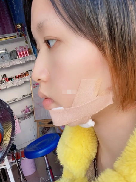 探讨垫下巴和使用玻尿酸两种丰下巴的方法,分析它们的优缺点