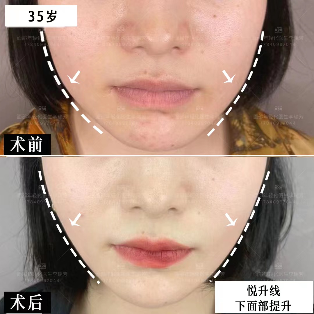 线雕悦升线中下面部提升改善下颌缘