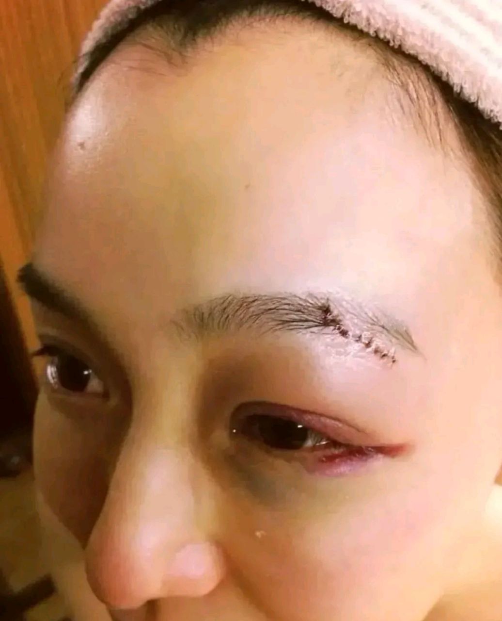 范玮琪疑似被陈建州家暴,眼部淤青好吓人,眉部还缝了几针