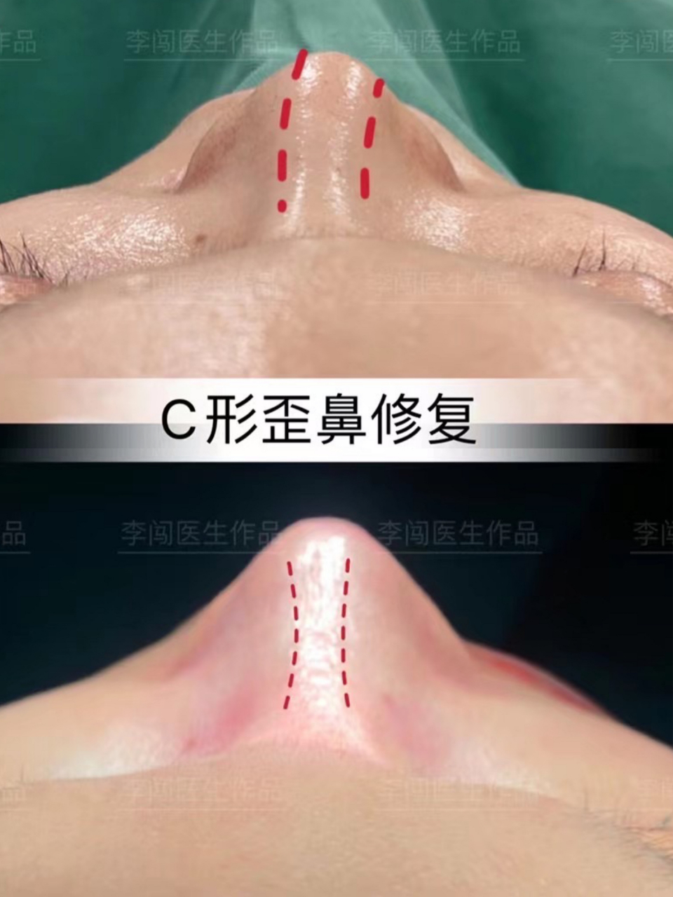 隆鼻术后c形歪鼻修复矫正  99肋软骨抬高鼻梁,一定会发生弯曲变形吗