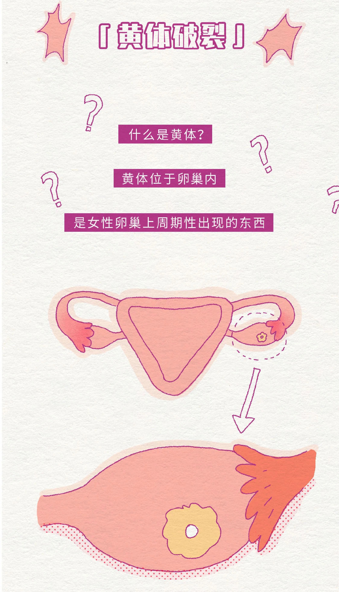 卵巢黄体破裂是怎么回事为什么会肚子疼  1外伤卵巢受直接或间接外力