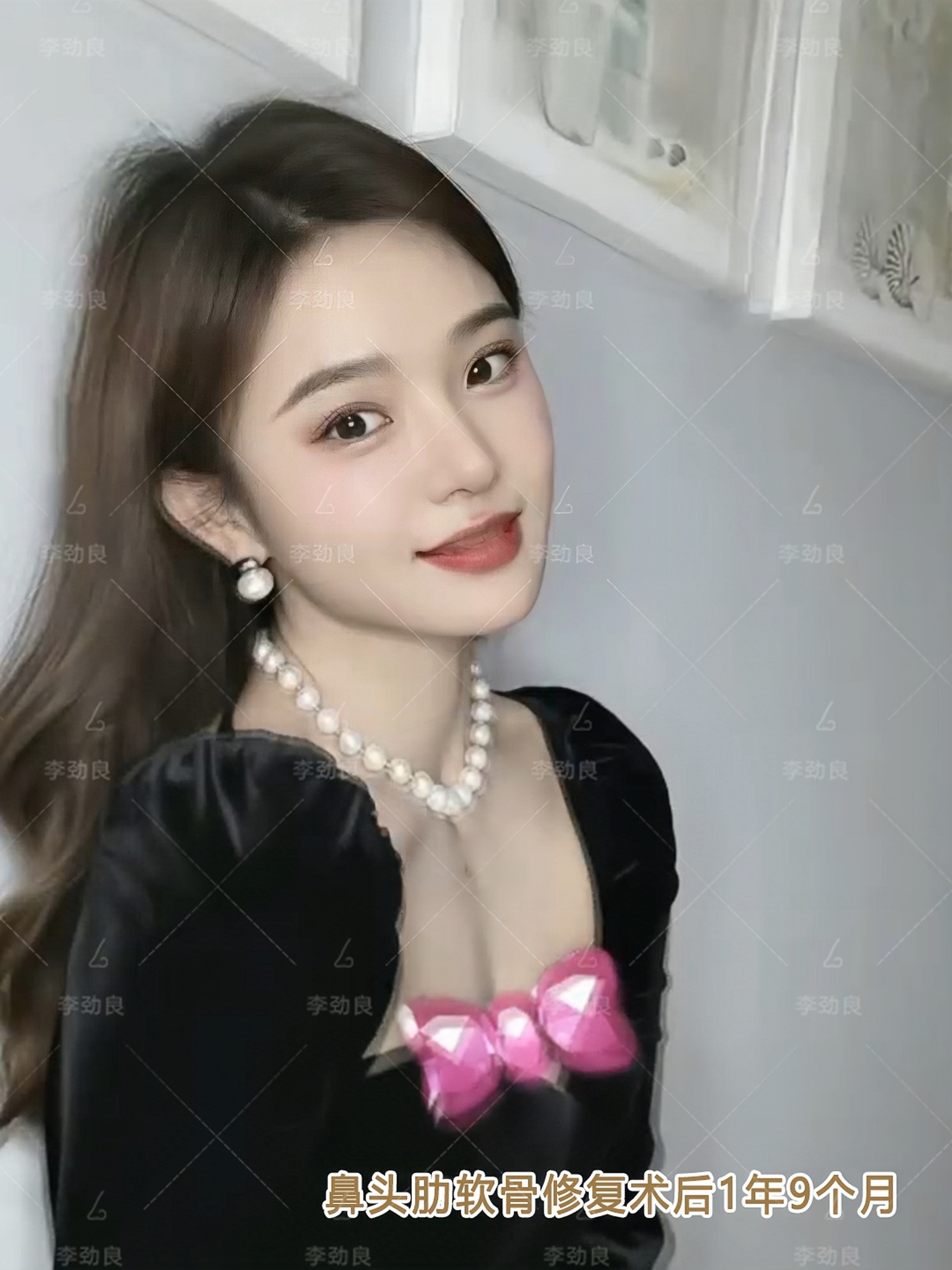 半肋综合修复调整重点降低鼻尖翘度改变过大过翘的鼻唇角延长鼻翼