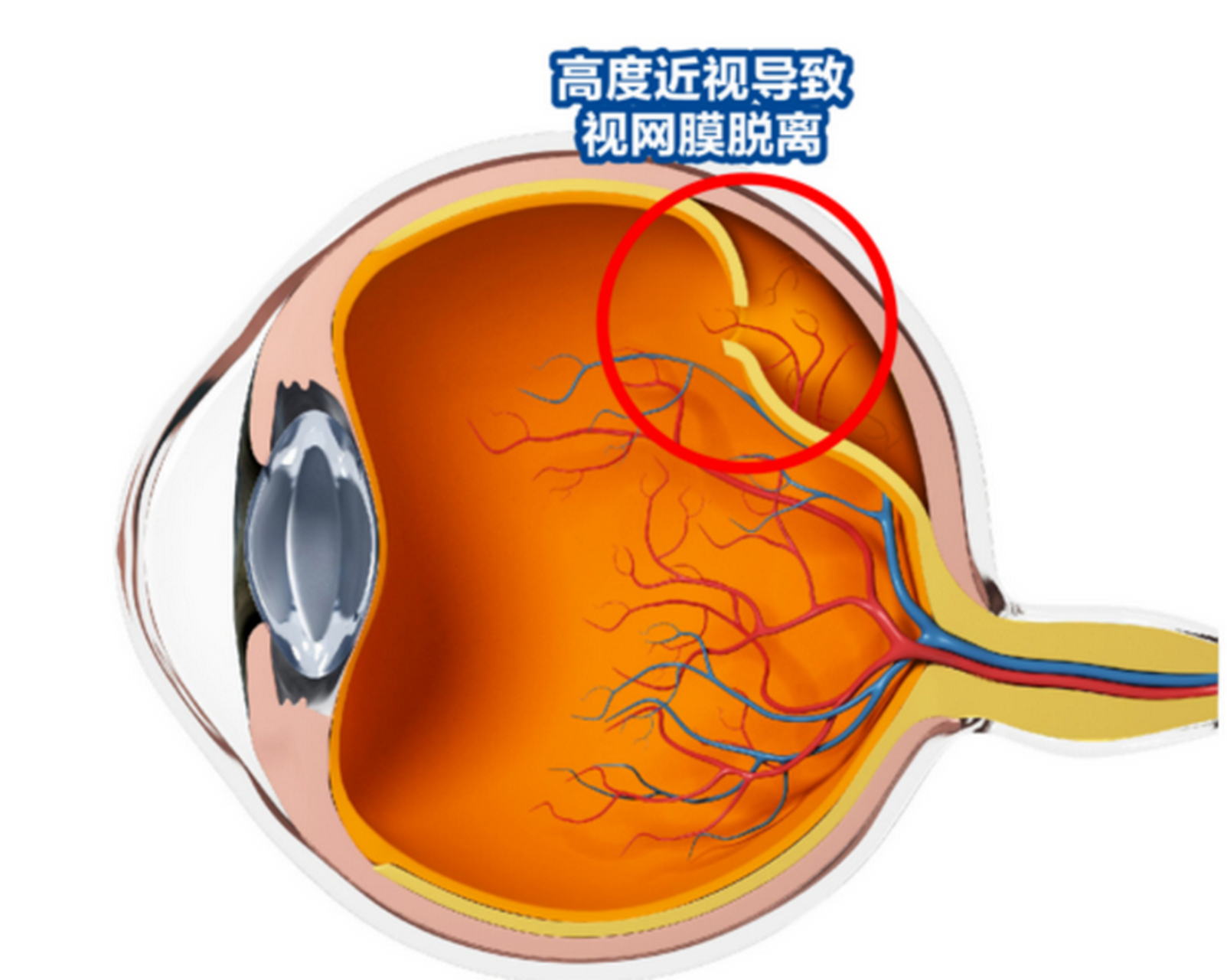 视网膜脱离手术后,这样做视力恢复的快  视网膜脱离手术对视网膜,神经