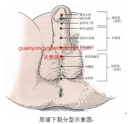 尿道下裂图片类型图片