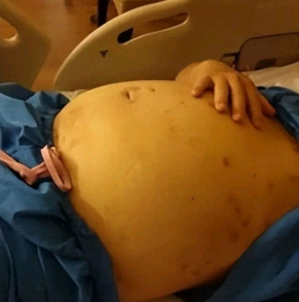 山东一男孩被同事以高压枪塞入肛门充气,肚子鼓得非常大,肚皮上的血管