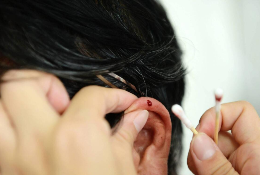 耳尖放血非常有效,它可以治疗许多疾病:流感,痤疮,高血压