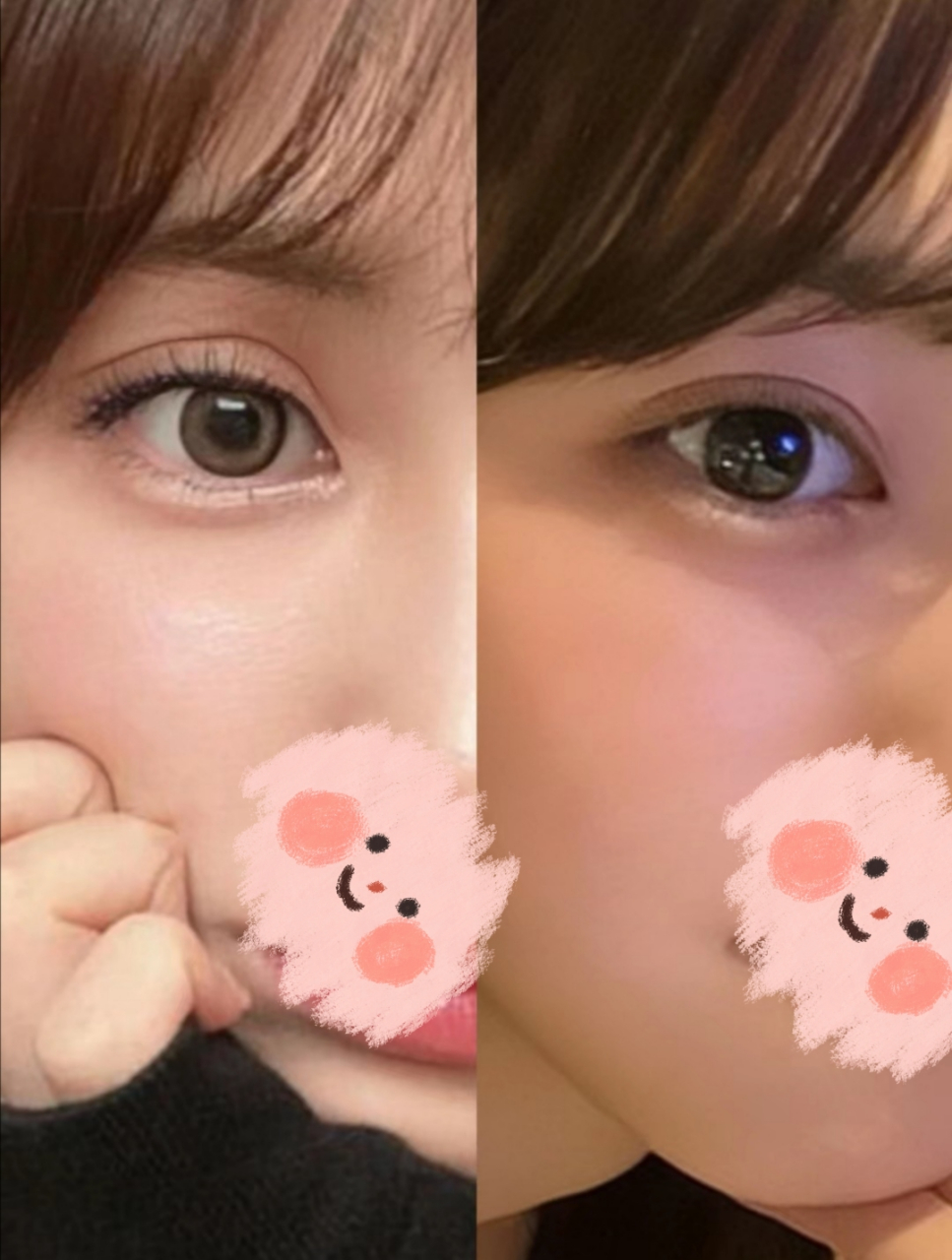 该求美者修复前做的欧式双眼皮,凹陷粘连,双眼皮线条不流畅,日常