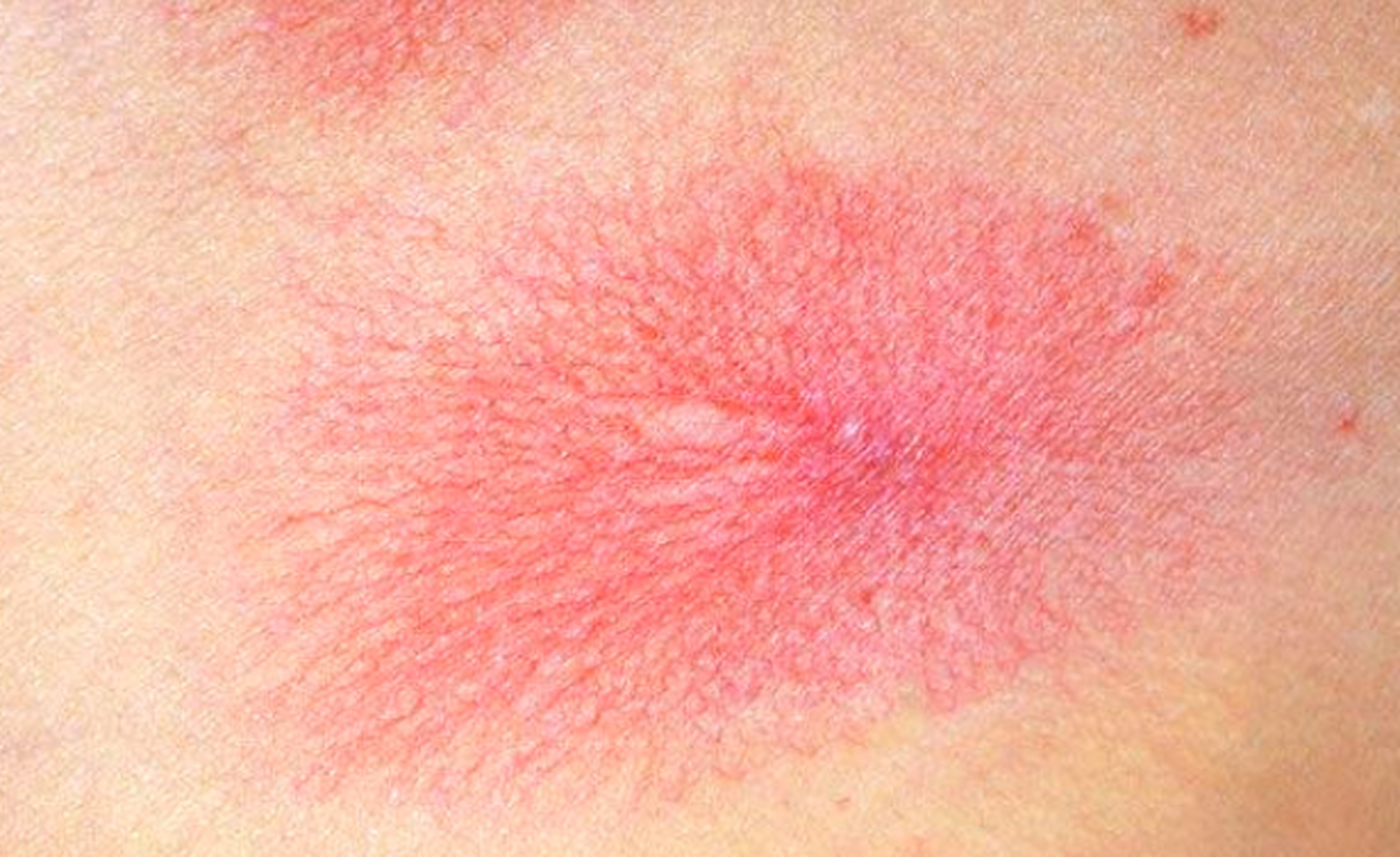 乙肝皮肤瘙痒初期图片图片