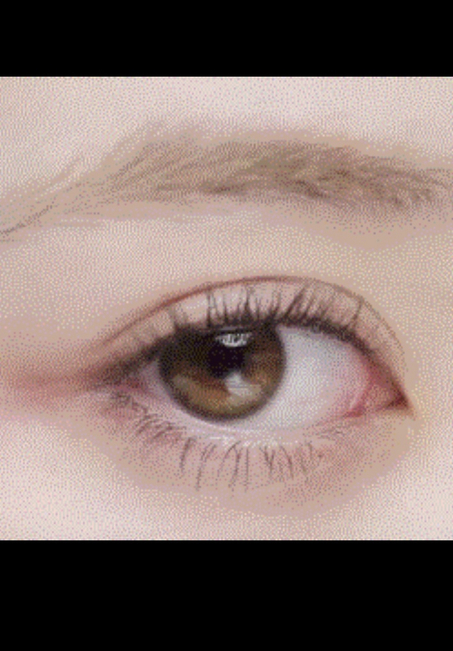 埋线双眼皮能维持几年  7815很多单眼皮的小伙伴想把自己眼皮弄成