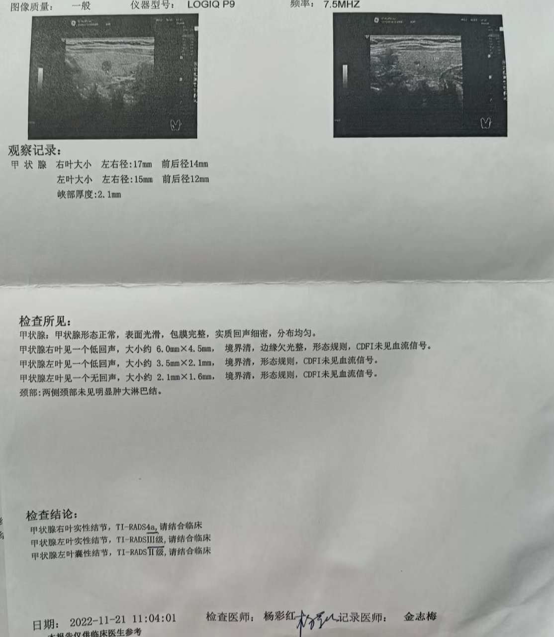 感谢贵人指点,坚持了两个月,甲状腺结节4a反转了!#甲状腺结节